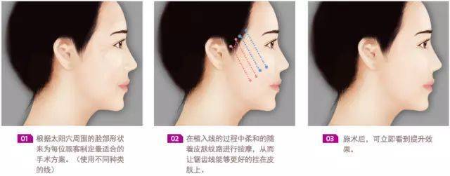 赶紧看！筋膜提升术是什么？筋膜提升和线雕有什么不一样？