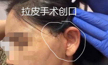赶紧看！筋膜提升术是什么？筋膜提升和线雕有什么不一样？