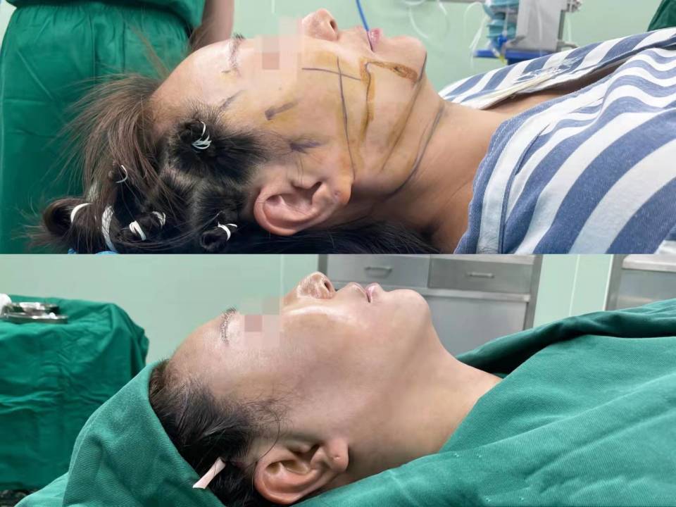 赶紧看！筋膜提升术是什么？筋膜提升和线雕有什么不一样？