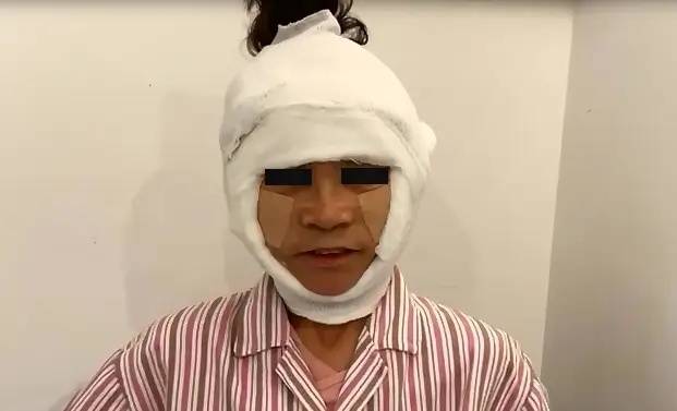 赶紧看！筋膜提升术是什么？筋膜提升和线雕有什么不一样？